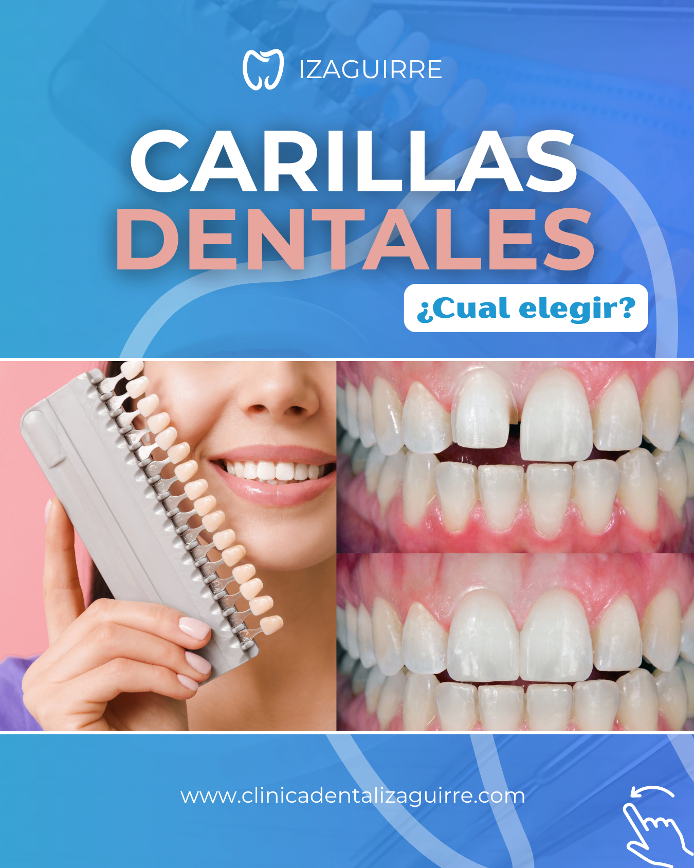 Portada · Carillas Dentales, ¿cuál elegir?