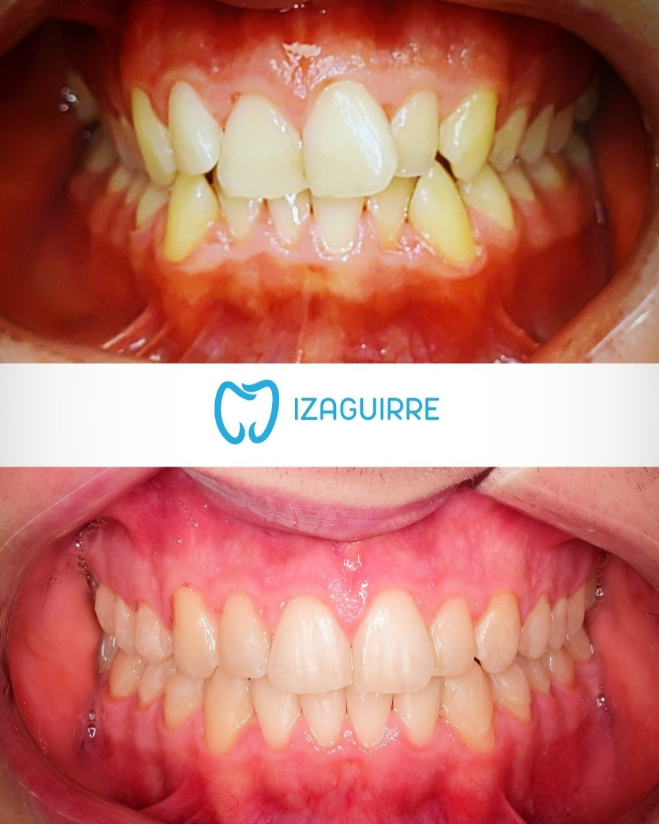 Antes y después · Ortodoncia · Clínica Dental Izaguirre